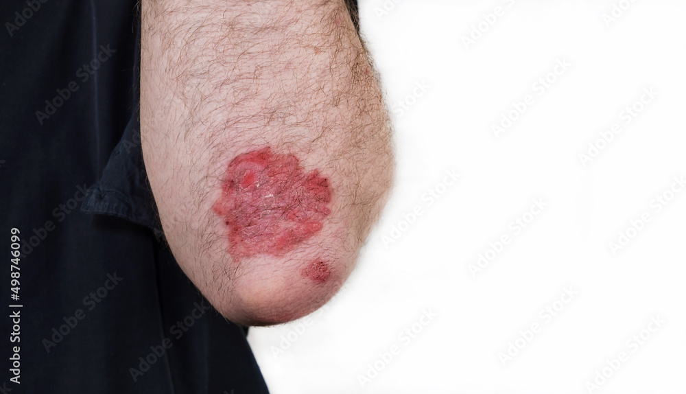 Psoriasis. Autoimmune disease. A man with sore hands, dry flaky