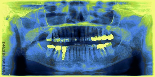 Dental panoramic of a 72 year old person with an implant and crowns. photo