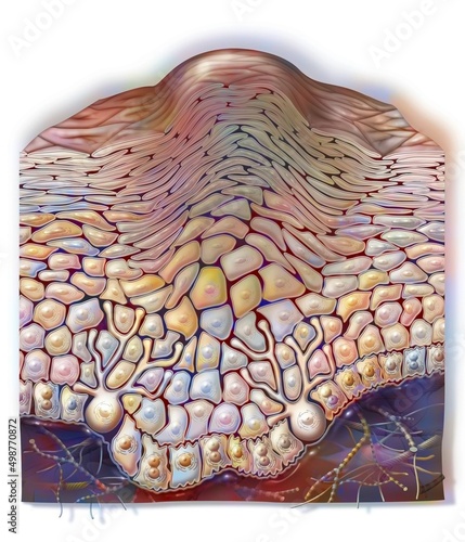 Common wart: benign skin epithelial tumor caused by papillomaviruses.