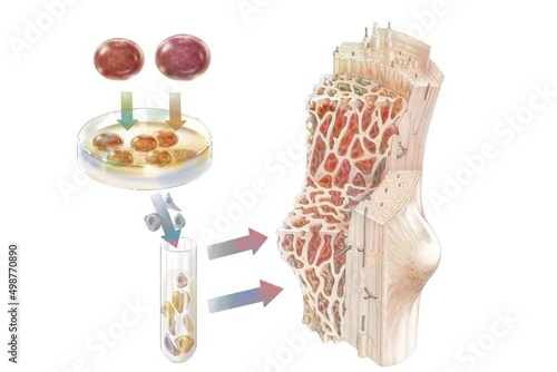 Slika na platnu Transplant of hematopoietic stem cells administered to colonize.