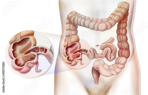 Colon (large intestine) with a zoom on the cecum. photo