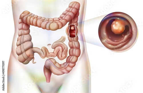 Digestive system: the colon with a colonic polyp. photo