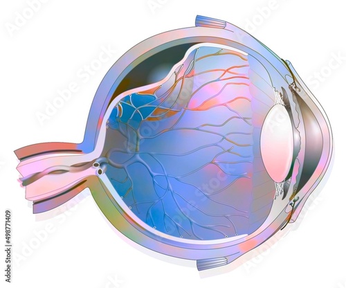 Eye: detachment of the retina.