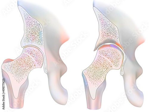 Healthy ankle and ankle with hemophilic arthropathy in frontal cut.