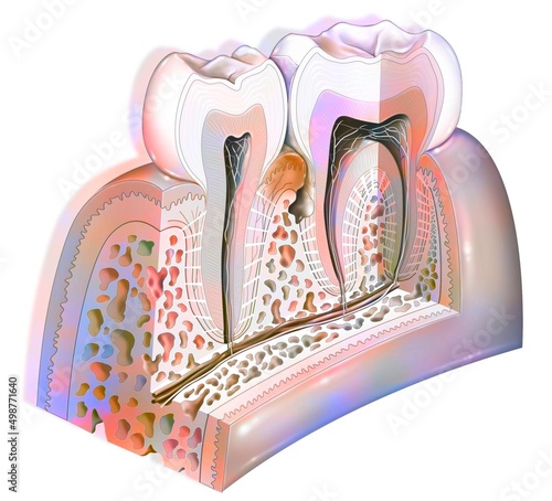 Dental plaque: main pathologies of the teeth: tartar gingivitis. photo