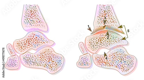 Comparison between a healthy ankle and hemophilic arthropathy. photo