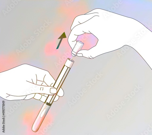 Dry swab for vaginal self-sampling.