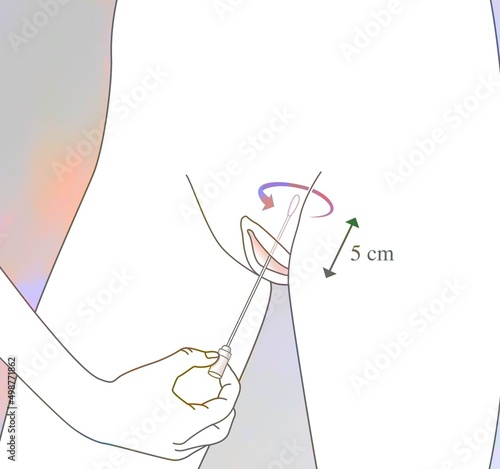 Introduction of the wet swab into the vagina (vaginal self-sampling).