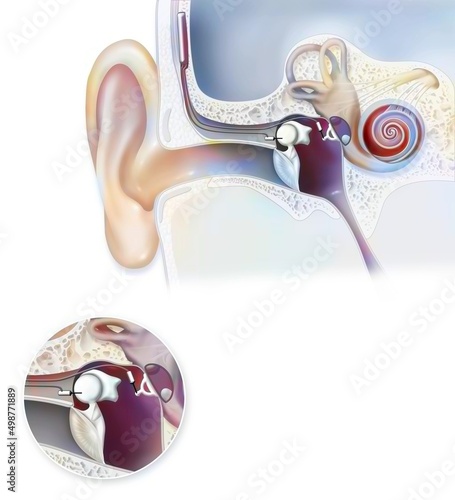 Ear: hearing aid (Esteem) implantable in the inner ear. photo