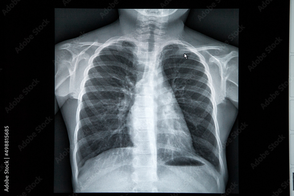 Normal chest x-ray in a child in a radiology center. Normal chest x-ray in a child in a radiology center.
