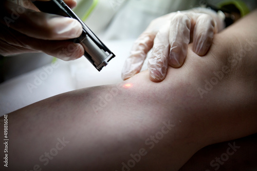Laser removal of spider veins from the legs in a beauty salon.