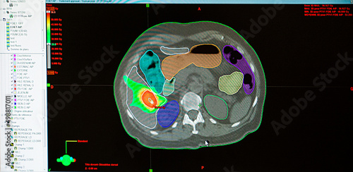 Konstfotografi Treatment of a liver tumor with radiotherapy.
