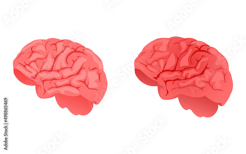 Vector illustration of a healthy and inflamed brain on a white background. brain disease