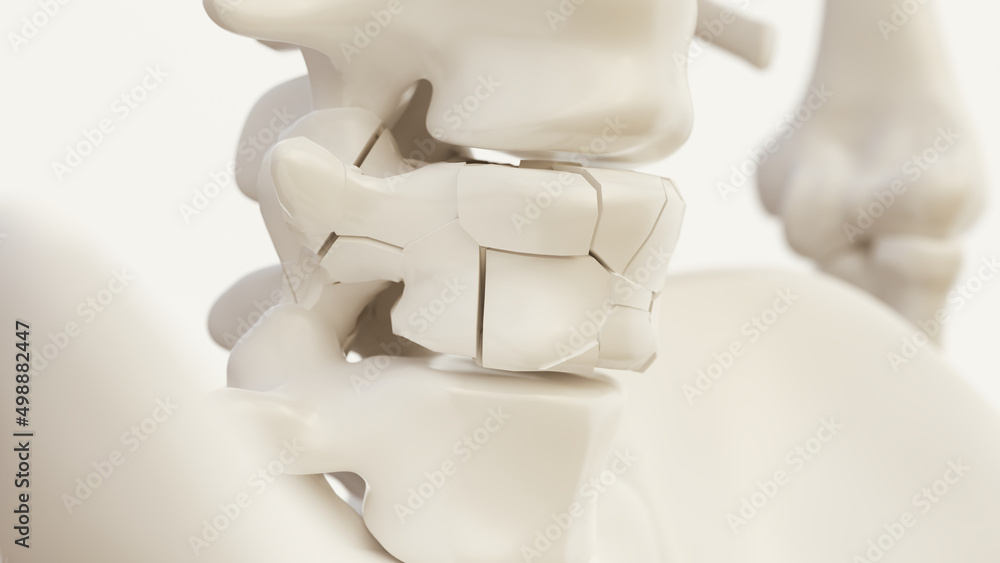 Vertebral fracture due to osteoporosis of the spine - 3d rendering Vertebral fracture due to osteoporosis of the spine - 3d rendering