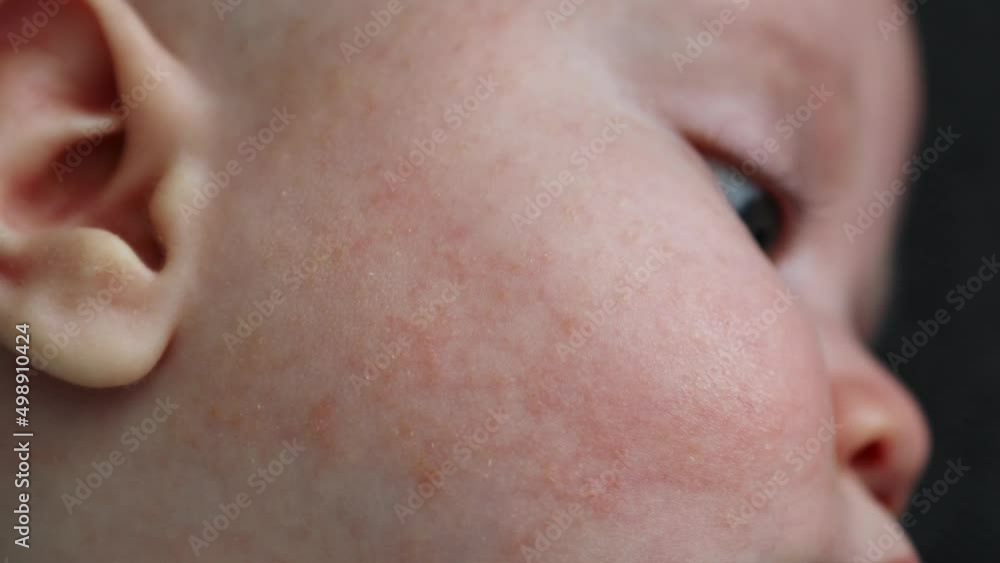 atopic dermatitis rush and allergic skin on baby infant cheek face, diathesis red pink pimples on newborn child skin problems. eczema on baby's face. sleeping caucasian infant with dermatitis atopic dermatitis rush and allergic skin on baby infant cheek face, diathesis red pink pimples on newborn child skin problems. eczema on baby's face. sleeping caucasian infant with dermatitis
