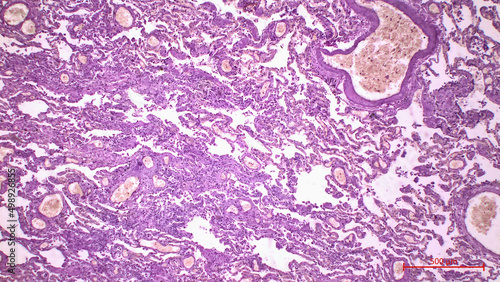 Histopathological data of the lungs in COVID-19 disease. Summary of histopathological features occurring in fatal cases of COVID-19 lung injury. Hematoxylin and Eosin Staining. photo