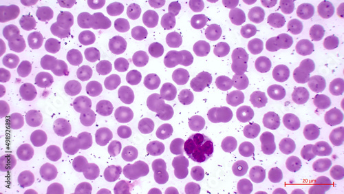 Blood smear. Light micrograph showing human blood cells. Erythrocytes are pink. They make up the majority of blood cells. Also in the center you can see a large cell with a nucleus (neutrophil). 