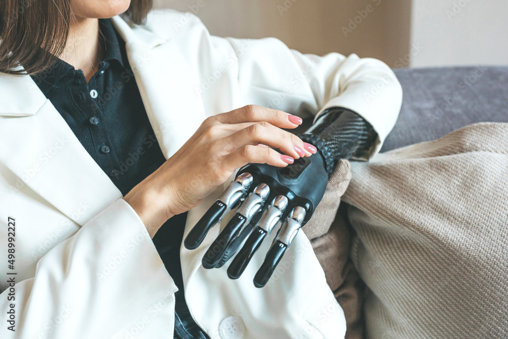 A woman with disabilities using a bionic prosthetic arm learns how to set up and turn on her prosthesis. Bioengineering, medicine of the future, progress, genetics