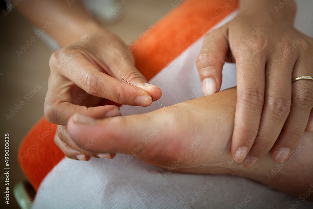 Fototapeta premium Naturopath putting acupuncture needles on a patient's foot.