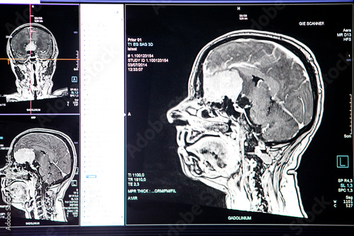 Brain images obtained by MRI in a radiology department of a hospital. photo