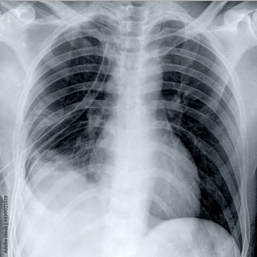 CHEST XRAY WITH COMPLICATED PNEUMONIA PLEURAL EFFUSION Stock Photo