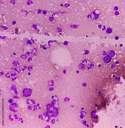 Bone marrow study: bone marrow cell with a lobated nucleus responsible for the production of blood thrombocytes, normal findings