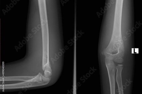 An x-ray image of  supracondylar humerus  fracture  
 photo