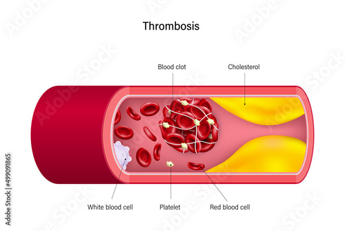 Thrombosis. Blood clots or thrombus block the flow of blood.