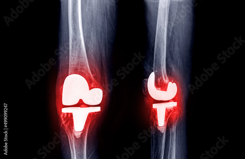 film x-ray  knee AP and lateral view of osteoarthritis knee patient and artificial joint with knee replacement. photo