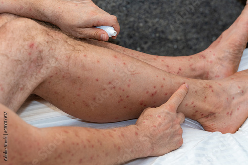 Bitten arms and legs by bloodthirsty insects in tropical countries, Lubricating itchy spots with ointment, Holiday health problems photo