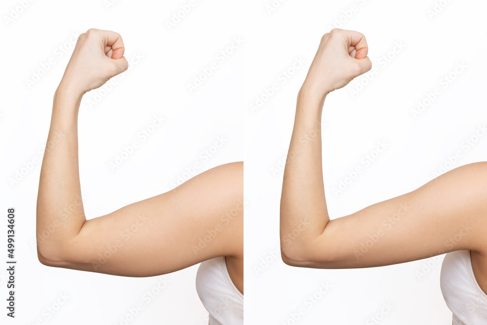 Two shots of a young woman with excess fat on her arm and toned arm before and after losing weight isolated on a white background. Result of diet, liposuction, training. Plastic surgery concept - obrazy, fototapety, plakaty 