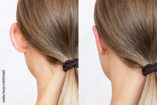 Cropped shot of woman's head with ears before and after otoplasty isolated on a white background. Result of cosmetic plastic surgery to correct the auricles and get rid of lop - eared. Beauty concept photo