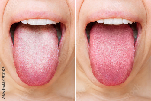 Fotografie, Obraz Female tongue with a white plaque
