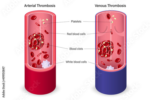 Arterial thrombosis and Venous thrombosis. Blood clots or thrombus block the flow of blood.
