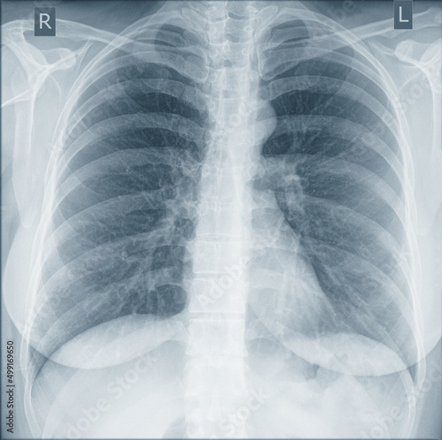 X-ray image of humen chest, for medical diagnosis photo