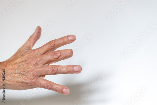Schilderij op canvas Man’s right hand with amputated middle finger on white background