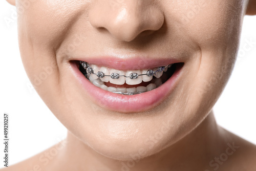 Woman with dental braces on white background, closeup photo