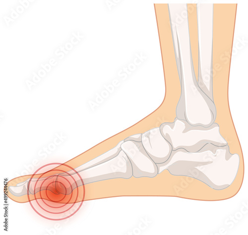 Hallux valgus types on white background