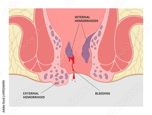 Thrombectomy thrombosis removal piles swollen blood anus treat band surgical home sitz baths colon cancer examine rectum pain ligator clots stapler PPH Laser regular lump Digital anal canal fistula
