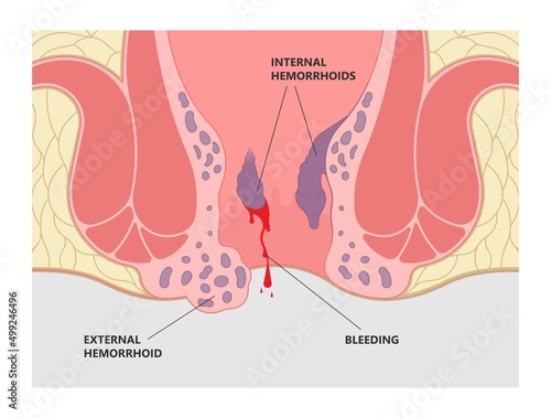 Thrombectomy thrombosis removal piles swollen blood anus treat band surgical home sitz baths colon cancer examine rectum pain ligator clots stapler PPH Laser regular lump Digital anal canal fistula photo