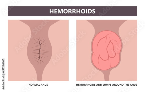 thrombectomy thrombosis fistula removal surgical Piles swollen blood anus treat band home sitz baths colon cancer examine rectum pain ligator clots stapler PPH Laser regular lump Digital anal canal