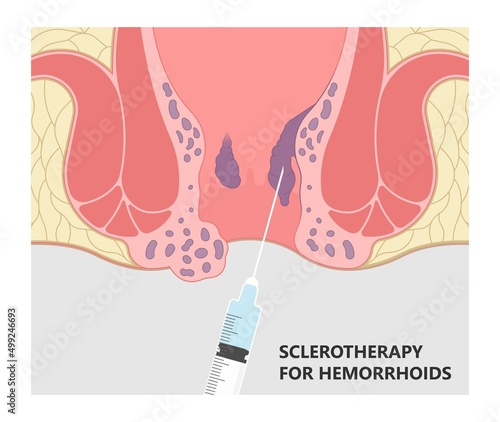 thrombectomy thrombosis fistula removal surgical Piles swollen blood anus treat band home sitz baths colon cancer examine rectum pain ligator clots stapler PPH Laser regular lump Digital anal canal