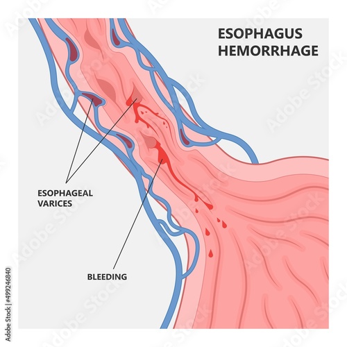 Oesophageal varicose swollen Nursing care Weiss tear upper gastric ulcer portal liver veins clot blood stools scarring A B fatty bile duct alcohol exam band variceal fibrosis GI blocked