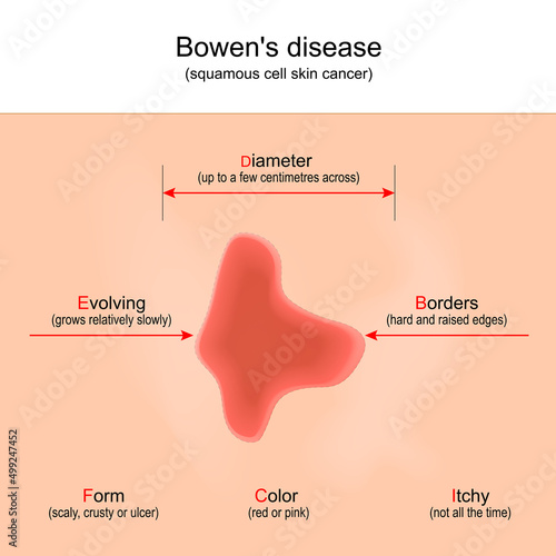 Bowen's disease. squamous cell skin cancer.