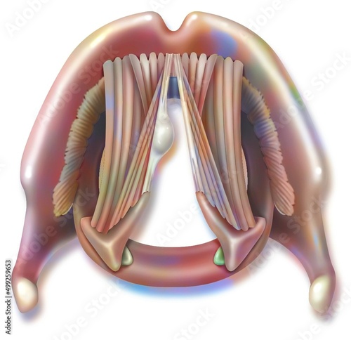 Polyp on a vocal cord with thyro-arytenoid muscles. photo