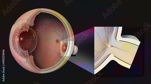 Normal eye with zoom on the papilla and the optic nerve.