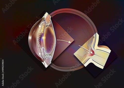 Glaucomatous eye with zooms of an open angle glaucoma.
