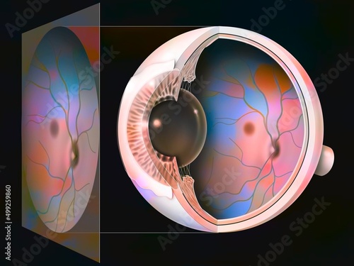 Fotografija Eye glaucoma: examination of a fundus with the result.