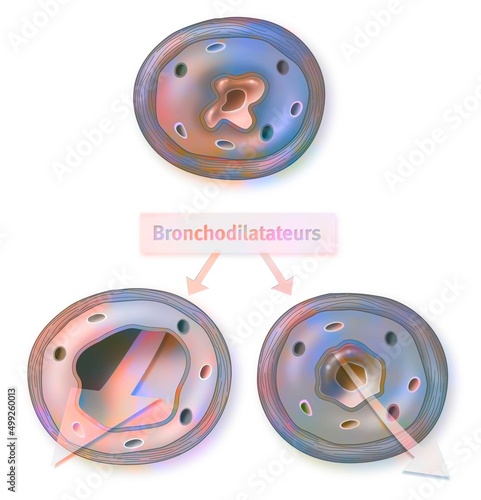 Effect of the bronchodilator on a bronchus with an asthma attack. photo