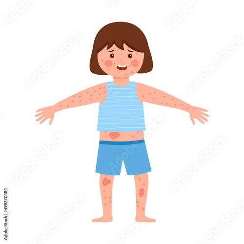 Girl children suffering from strong allergy skin itchy symptom in flat design. Red rash skin irritation.